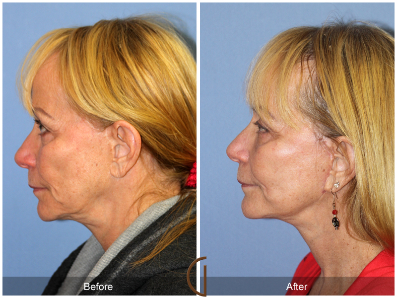 Female Facelift  Before & After Image