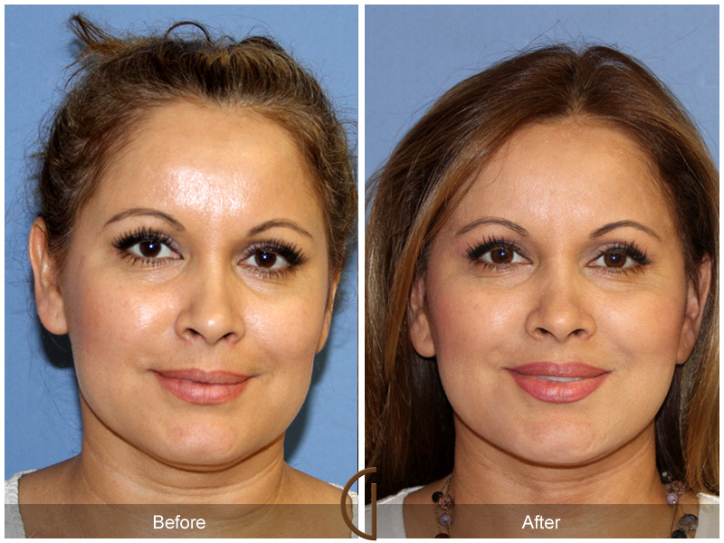 Female Facelift  Before & After Image