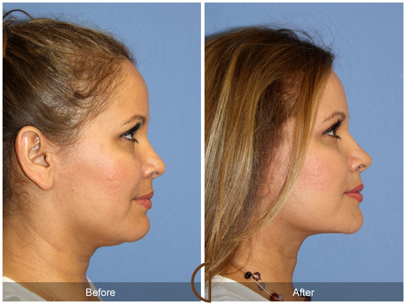 Female Facelift  Before & After Image