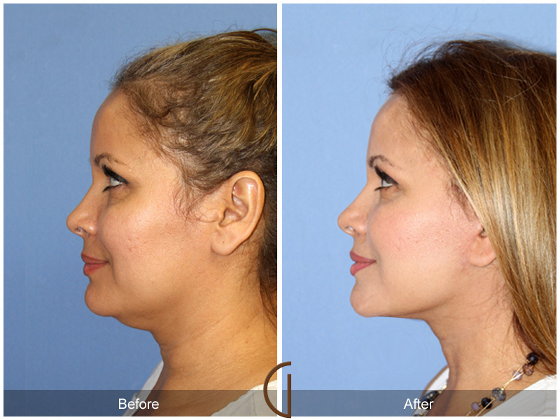 Female Facelift  Before & After Image