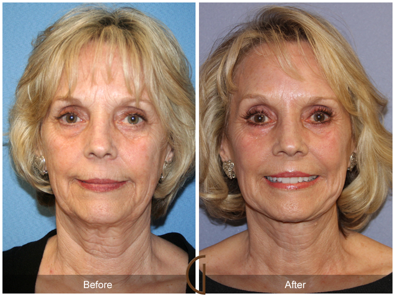 Female Facelift  Before & After Image