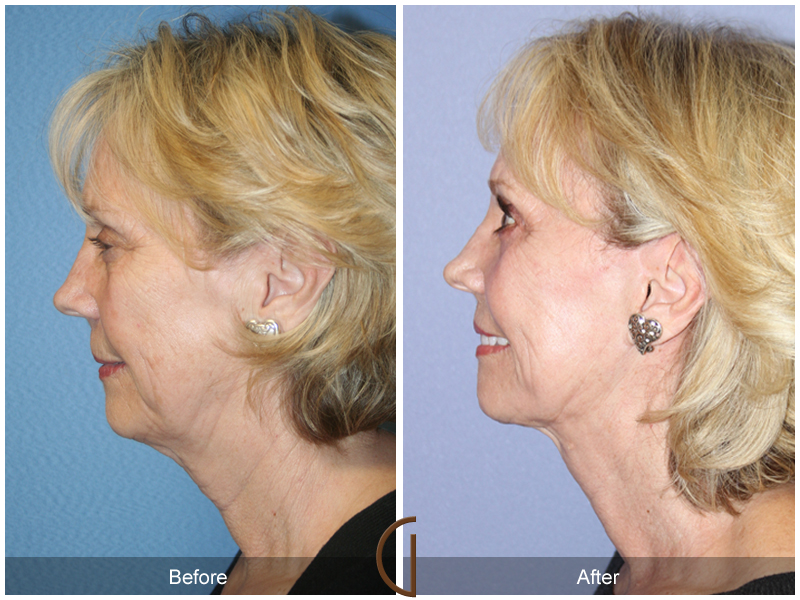 Female Facelift  Before & After Image