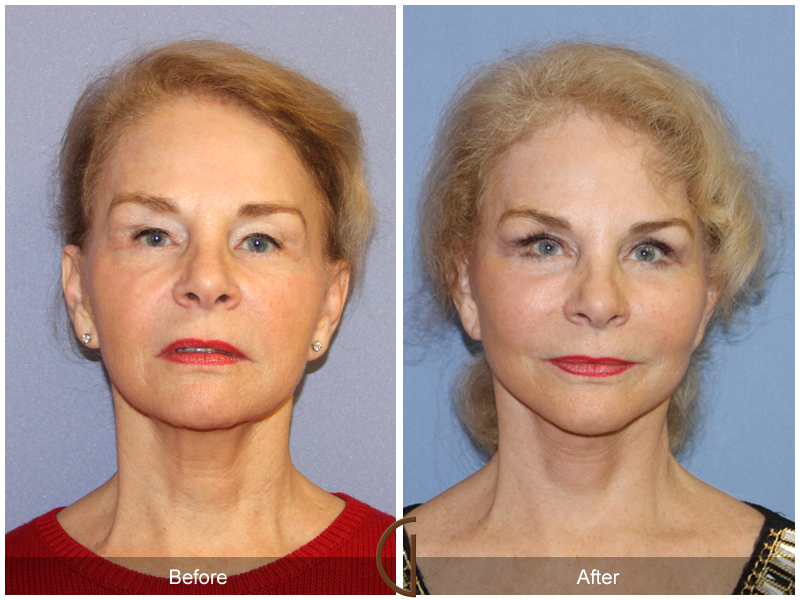 Female Facelift  Before & After Image