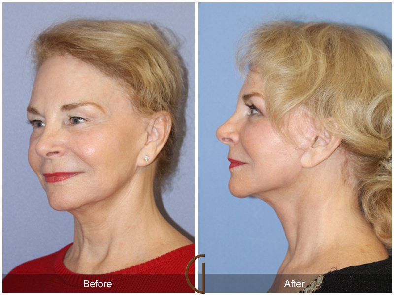 Female Facelift  Before & After Image