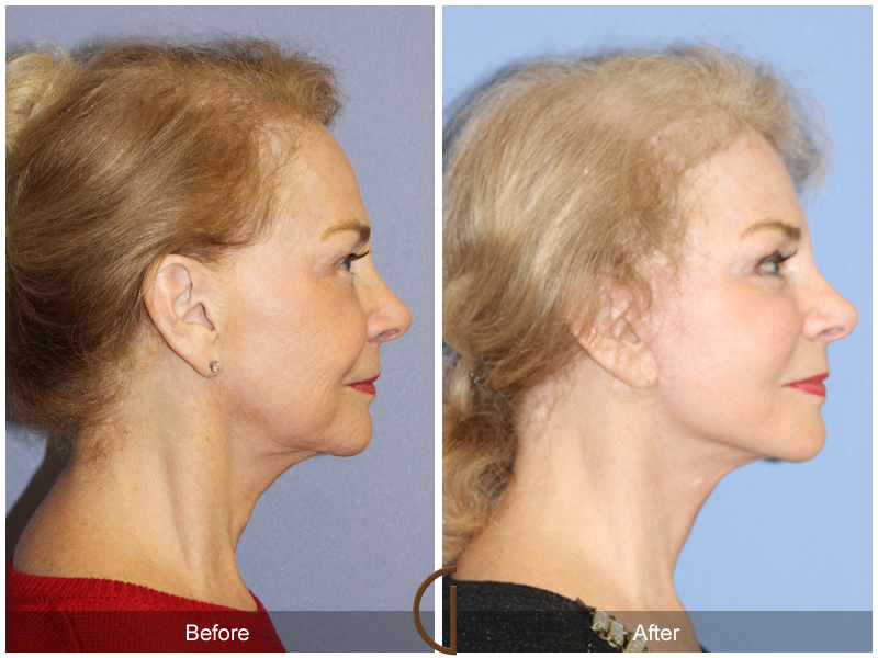 Female Facelift  Before & After Image