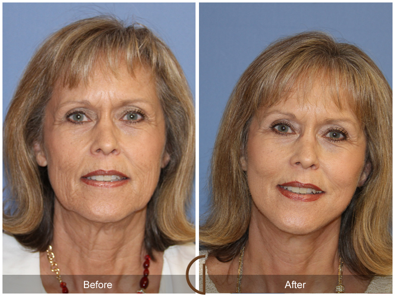 Female Facelift  Before & After Image