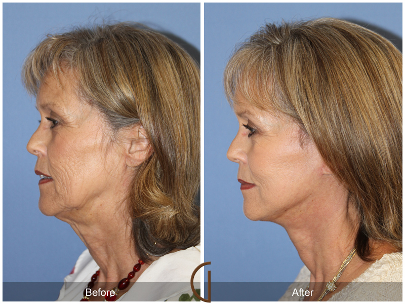 Female Facelift  Before & After Image