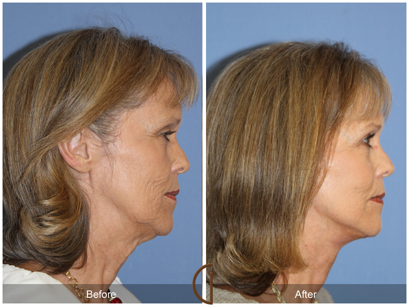 Female Facelift  Before & After Image