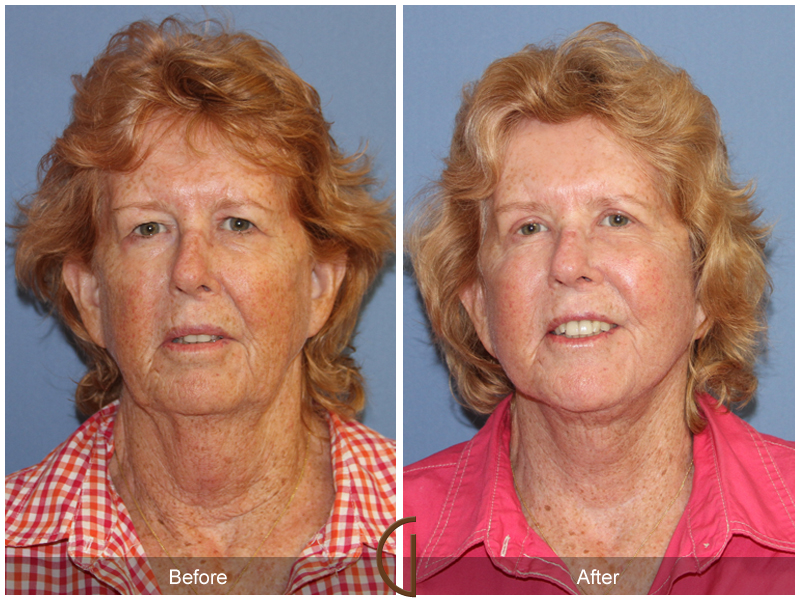 Female Facelift  Before & After Image