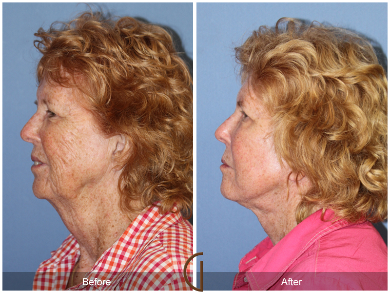 Female Facelift  Before & After Image