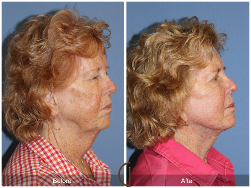 Female Facelift  Before & After Image