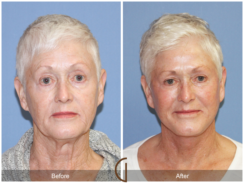 Female Facelift  Before & After Image