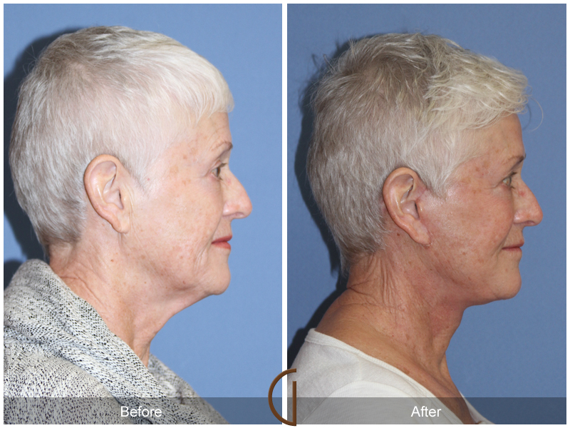 Female Facelift  Before & After Image