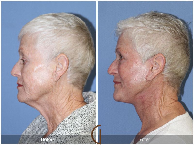 Female Facelift  Before & After Image