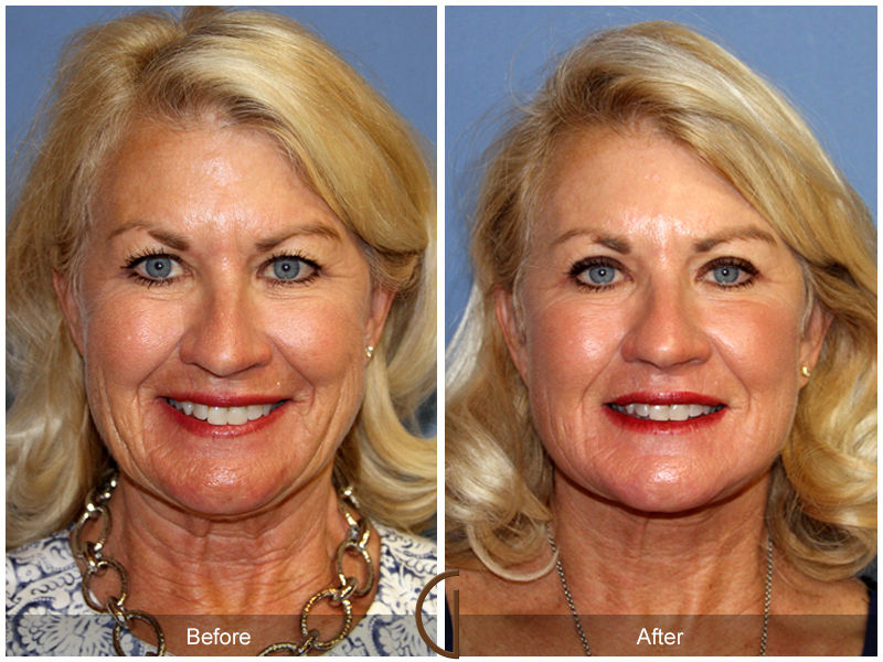 Female Facelift  Before & After Image