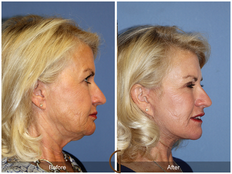 Female Facelift  Before & After Image