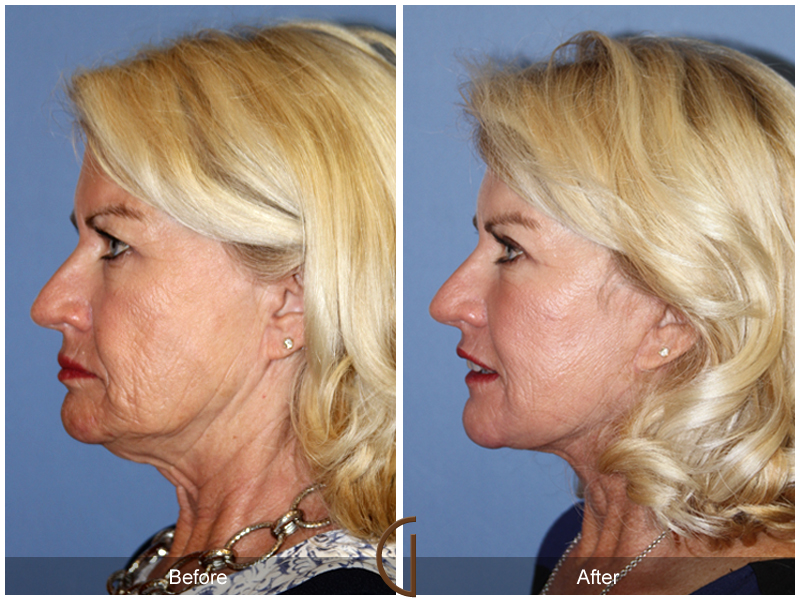 Female Facelift  Before & After Image