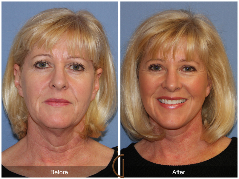 Female Facelift  Before & After Image