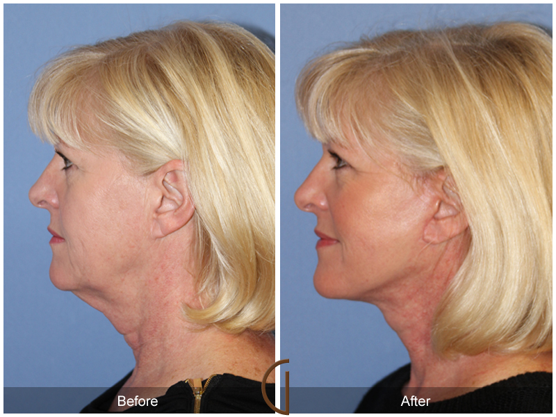 Female Facelift  Before & After Image