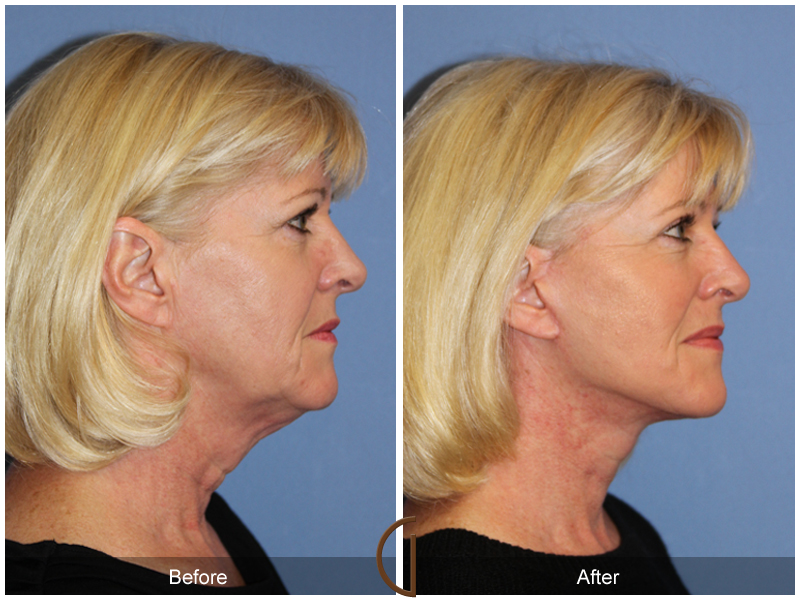 Female Facelift  Before & After Image