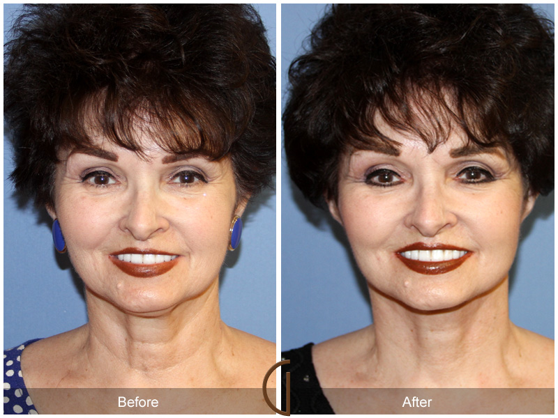 Female Facelift  Before & After Image