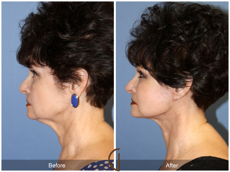 Female Facelift  Before & After Image