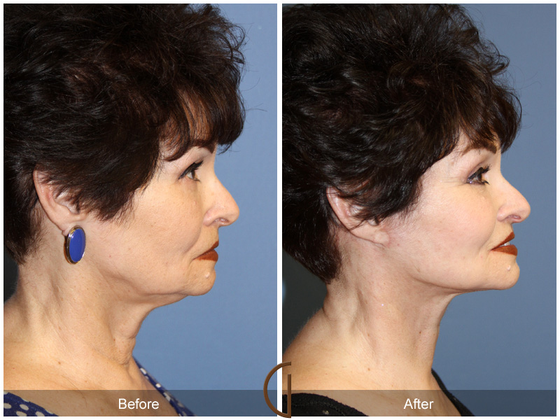 Female Facelift  Before & After Image