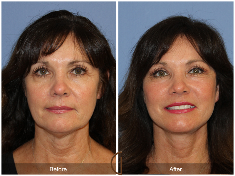 Female Facelift  Before & After Image