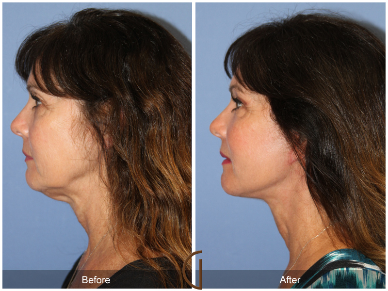 Female Facelift  Before & After Image