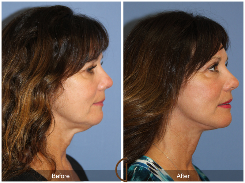 Female Facelift  Before & After Image