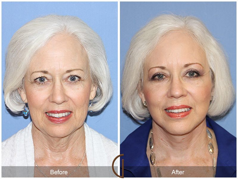 Female Facelift  Before & After Image