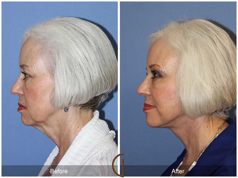 Female Facelift  Before & After Image