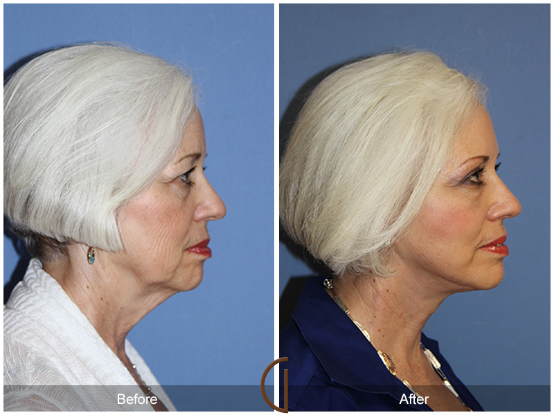 Female Facelift  Before & After Image