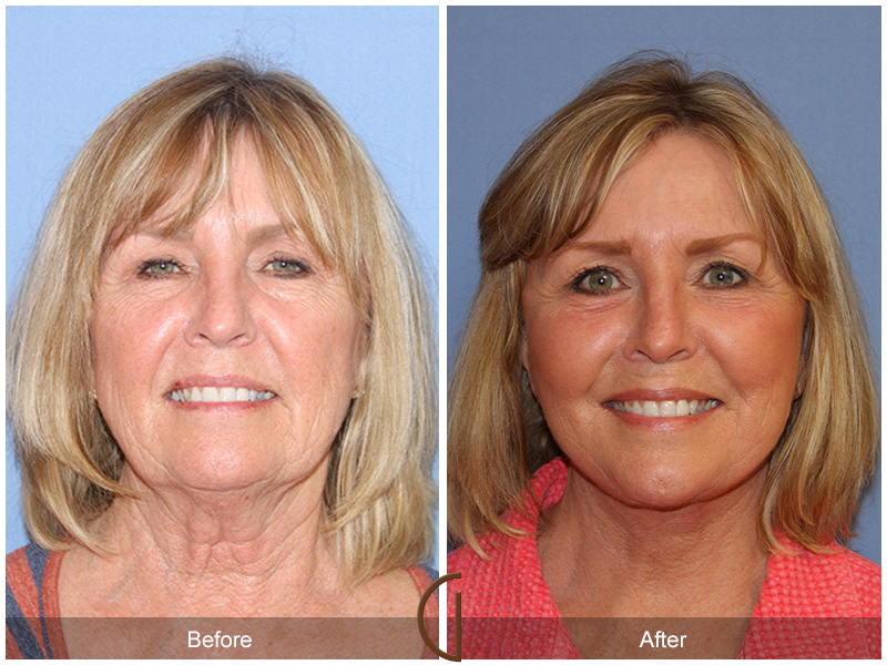 Female Facelift  Before & After Image