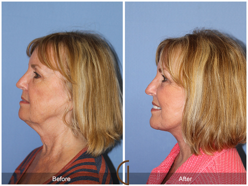 Female Facelift  Before & After Image