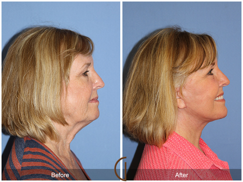 Female Facelift  Before & After Image