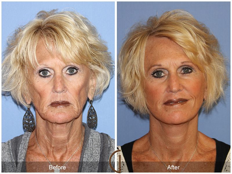 Female Facelift  Before & After Image