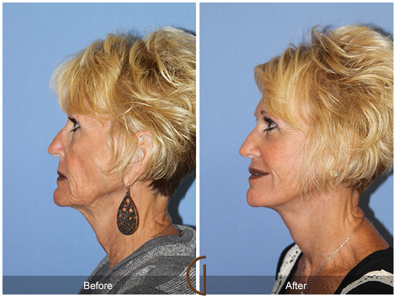 Female Facelift  Before & After Image