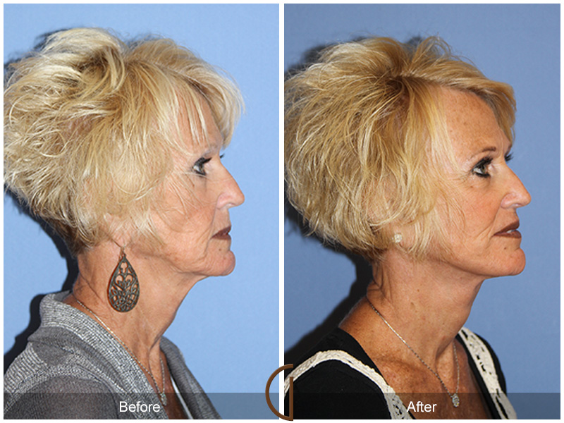 Female Facelift  Before & After Image