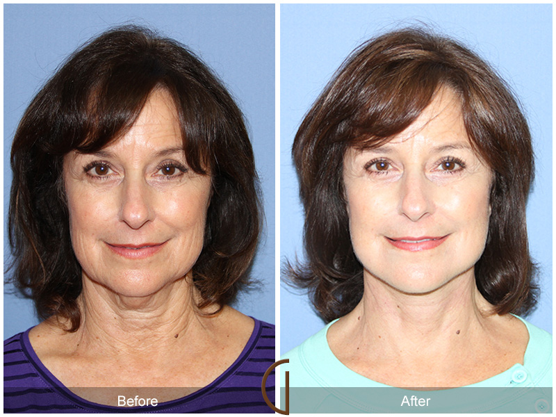 Female Facelift  Before & After Image