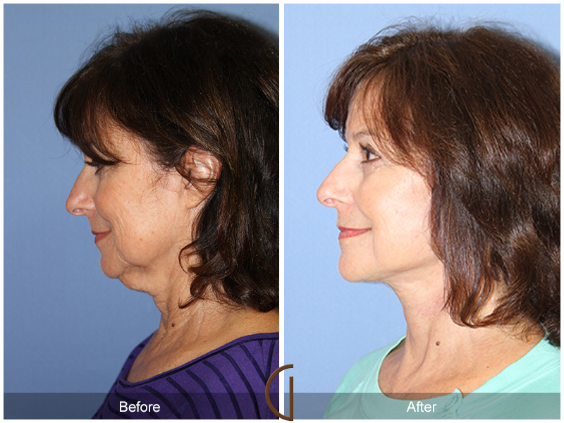 Female Facelift  Before & After Image