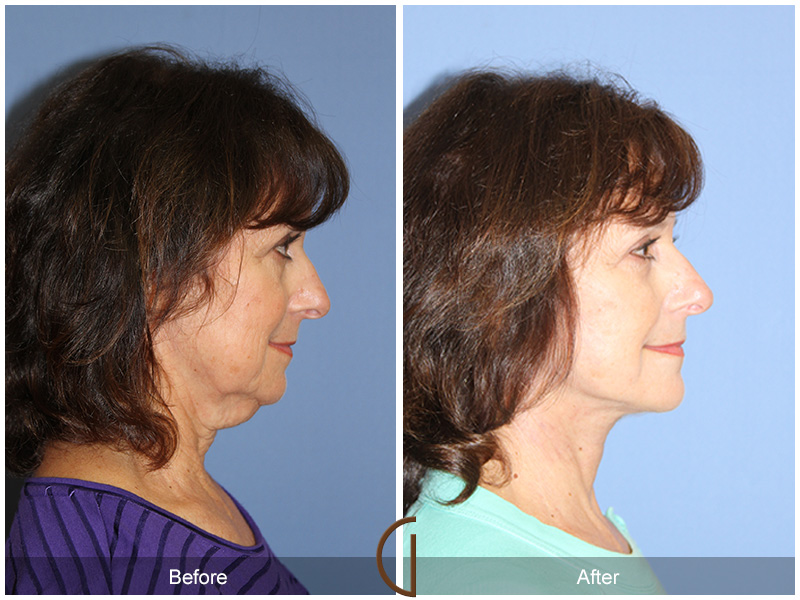 Female Facelift  Before & After Image