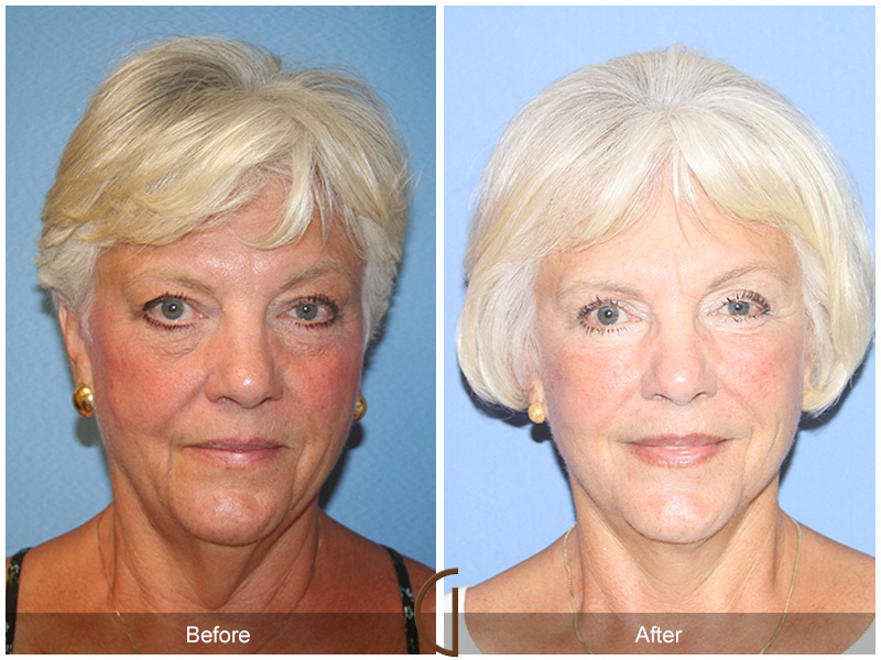 Female Facelift  Before & After Image