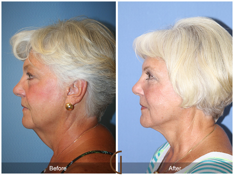 Female Facelift  Before & After Image