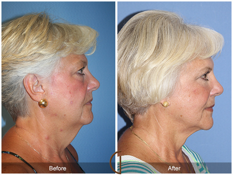 Female Facelift  Before & After Image