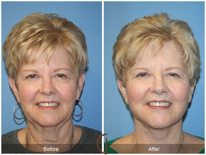 Female Facelift  Before & After Image