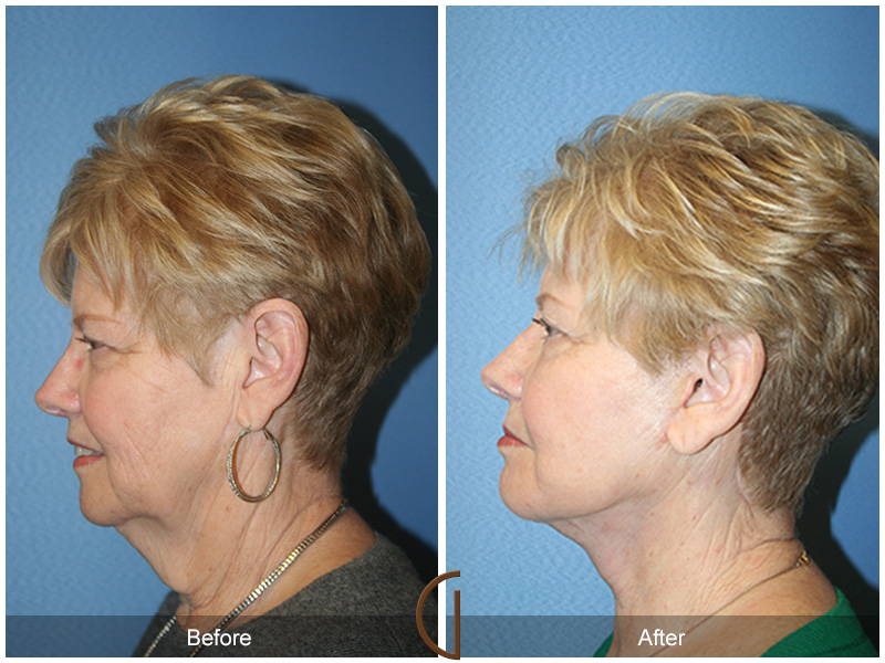 Female Facelift  Before & After Image