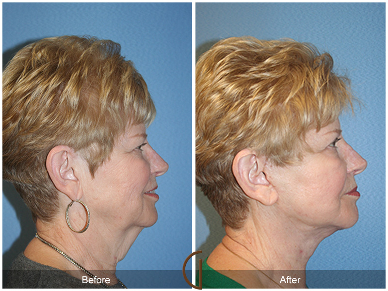 Female Facelift  Before & After Image