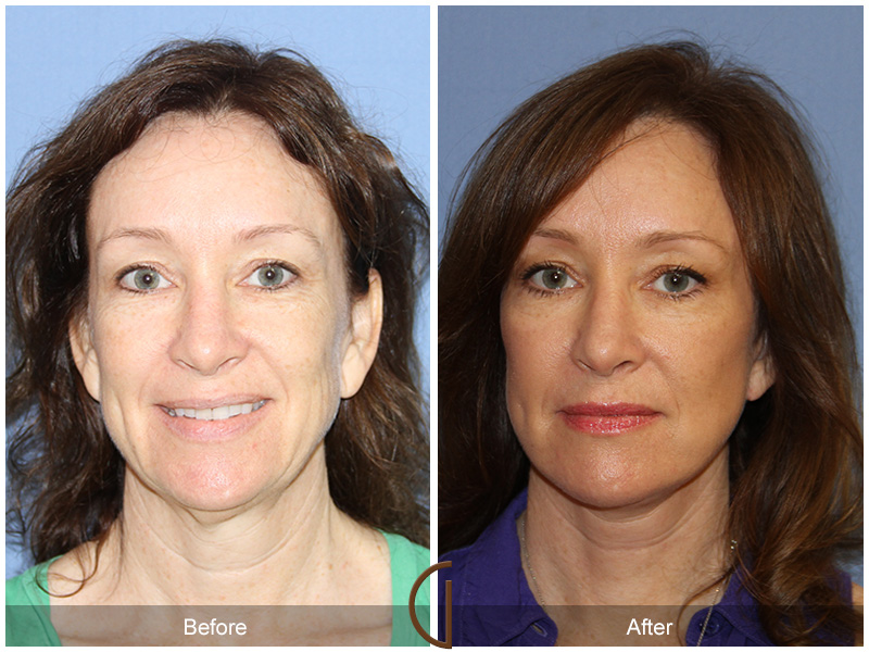 Female Facelift  Before & After Image