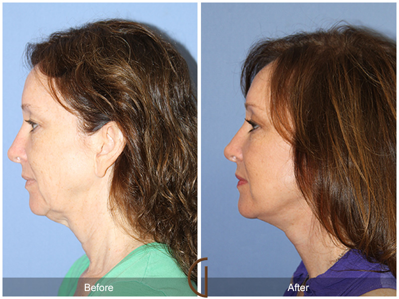 Female Facelift  Before & After Image